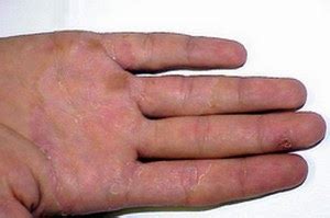 Hand Fungus – Symptoms, Causes, Pictures and Treatment