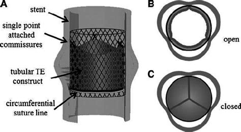 Concept Of The Tube In Stent Valve A Tube In Stent Valve Placed In Download Scientific