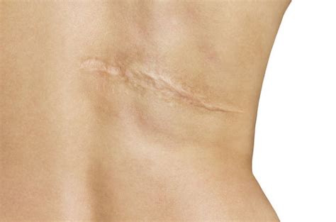 Preventing scars after a burn wound – Alhydran.co.uk