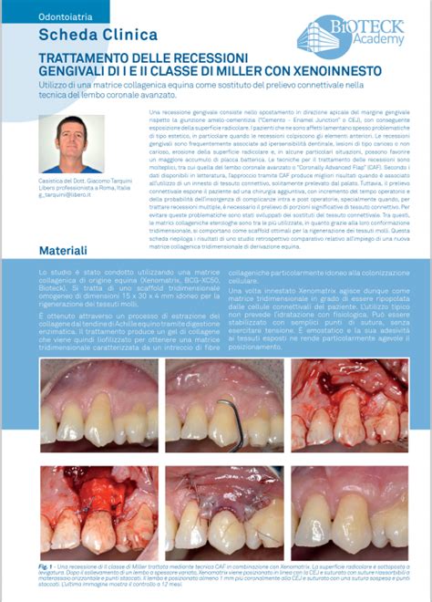 Terapia Chirurgica Delle Recessioni Gengivali Mediante Caf Innesto Di