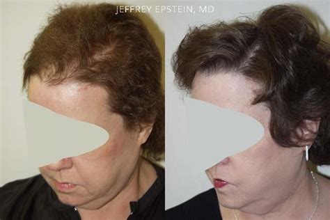 Hair Transplants For Women Photos Miami Fl Patient41707