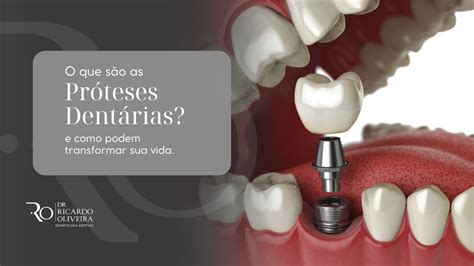 O que são as Próteses Dentárias e como podem transformar sua vida