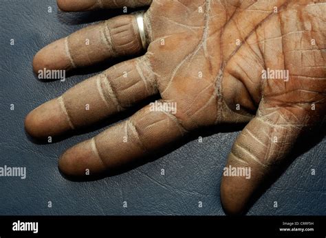 Ein Patient Mit Ichthyosis Vulgaris Die Auswirkungen Auf Seine Hand