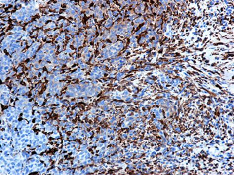 Positive Immunostaining For Sma Of Tumor Cells Original Magnification