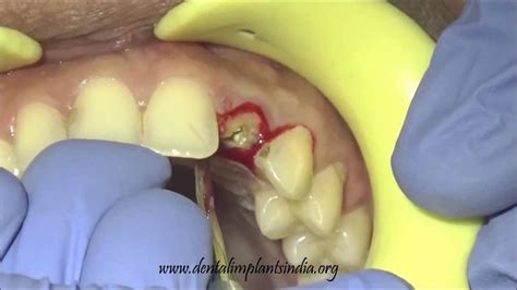 Upper Lateral Incisor Extraction And Immediate Basal Implant With