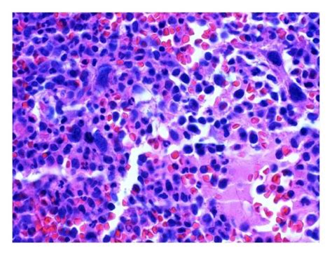 A First Bone Marrow Biopsy Showing Hypercellular Marrow Packed With