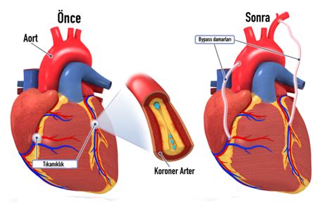 Koroner Arter Bypass Greft Cerrahisi Kardiyopulmoner Rehabilitasyon Faz