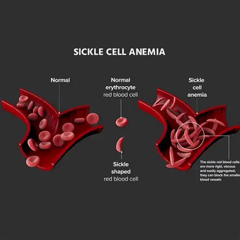 Book Sickle Cell Anemia Mutation Detection | Test Price In Delhi ...