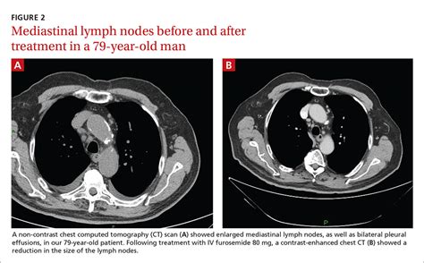 Two men with dyspnea, enlarged lymph nodes • Dx? | MDedge Family Medicine