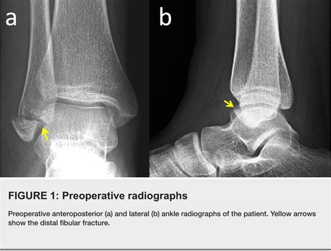 Figure 1 from Isolated Lateral Malleolar Fracture Treated with a ...