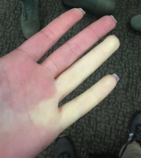 Raynaud’s Phenomenon can turn fingers white - Villages-News.com