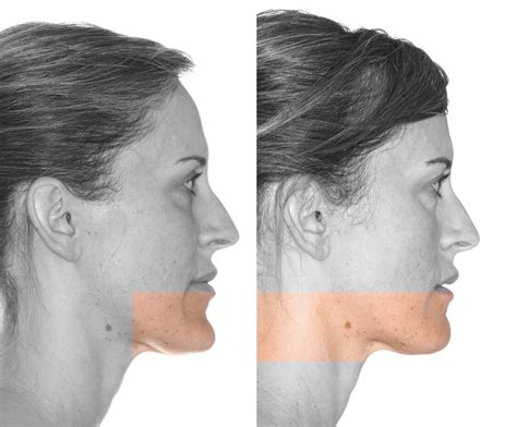 Mentoplastia Caso Instituto Maxilofacial