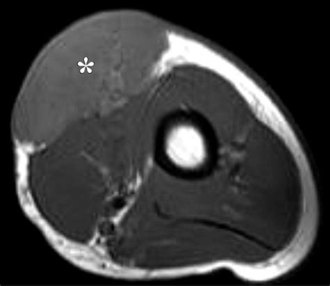 Superficial Soft Tissue Masses Analysis Diagnosis And Differential Considerations Radiographics