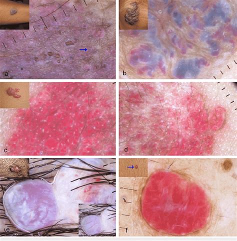 Dermoscopic Features Of Vascular Malformations And Tumors Polarized Download Scientific