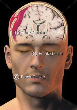 Gehirnverletzung durch Schädel Hirn Trauma Schädeltrauma mit