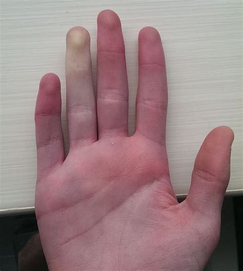 Fenomena Raynaud Penyebab Gejala Diagnosis Pengobatan