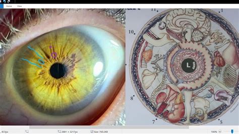 Iridology Lesson Iris Reading Youtube