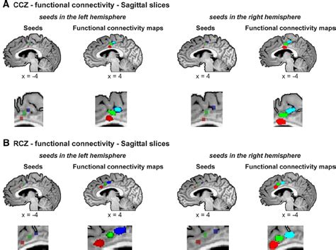 Whole Brain Functional Connectivity Analysis Reveals Interhemispheric Download Scientific