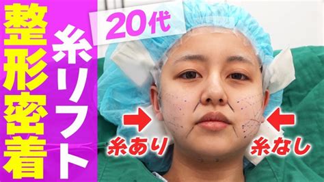 糸リフト整形の施術前からダウンタイム1週間後まで全て公開します【密着】 美容医療・整形情報♡動画まとめるん