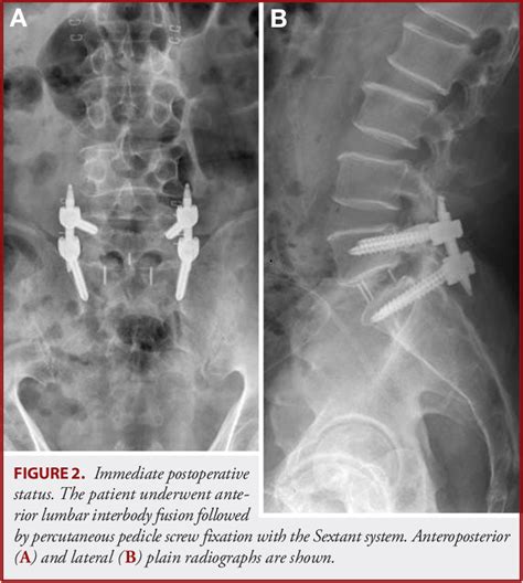 Figure 2 From Iatrogenic Sacroiliac Joint Syndrome After Percutaneous