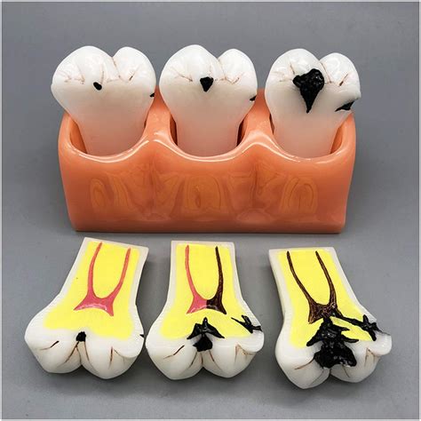 Buy Fhuili X Large Teeth Model Tooth Decay Pathological Caries Model