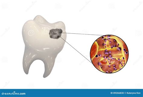 Zahn Mit Zahnmedizinischer Karies Stock Abbildung - Illustration von ...