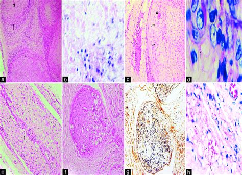 Nerve Biopsy Features Of Leprosy 2a Section Shows Nerve Funicles With