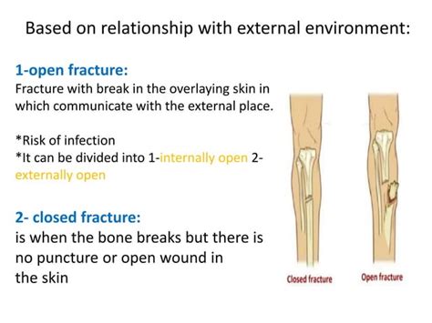 Classification Of Fracture Ppt