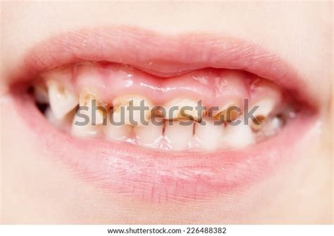 2,057 Baby Teeth Decay Images, Stock Photos & Vectors | Shutterstock