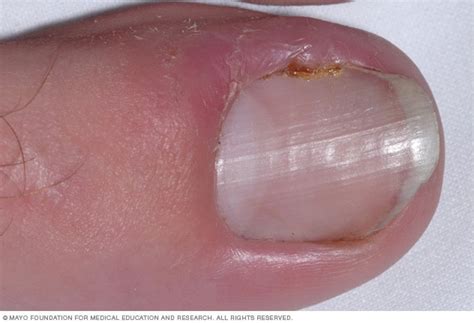 Ingrown Toenails Symptoms And Causes Mayo Clinic