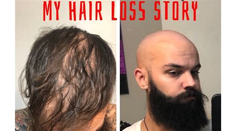 My Hair Loss Story Youtube