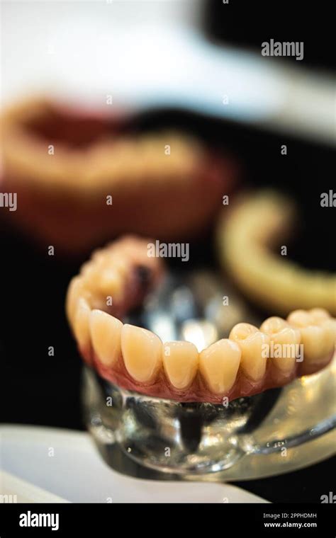 Dental Prosthesis With Metal Stock Photo Alamy