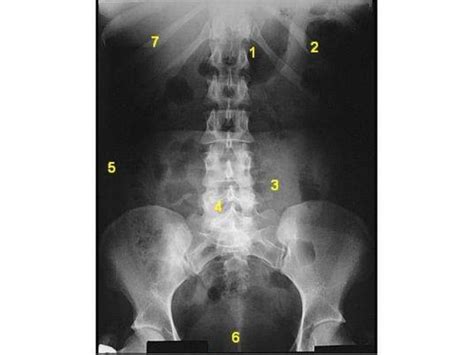 Radiographic Anatomy Of Abdomen Region PPT