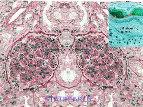 [figure Poststreptococcal Glomerulonephritis Image Courtesy S Bhimji