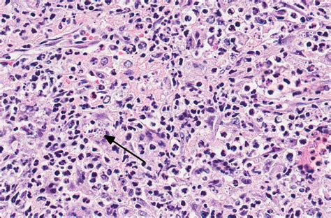 Sporothrix Schenckii Histology