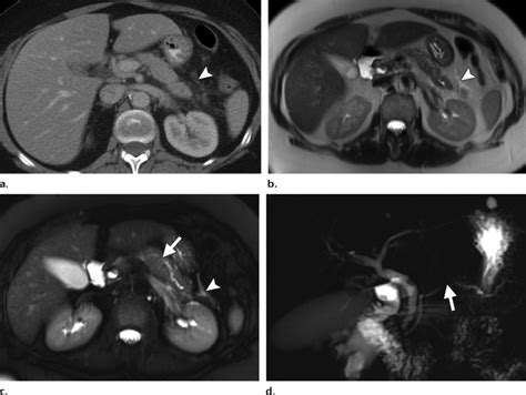 Pancreatic Duct Stricture In A 57 Year Old Woman Who Presented To The Download Scientific