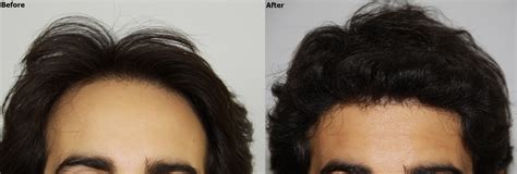 Dense Packing Hair Restoration Result Alvi Armani Hair Transplant