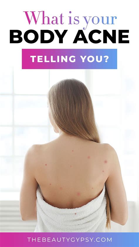 What Is Your Body Acne Telling You In Body Acne Body Pimples