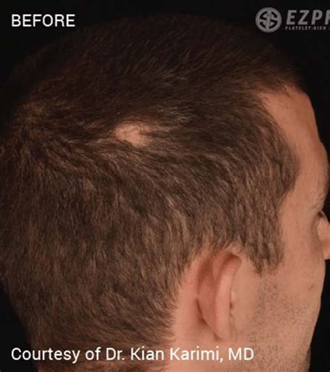 PRF Hair Restoration Archives Sculpt MD