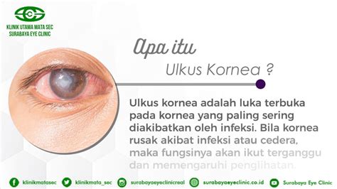 Apa Itu Ulkus Kornea Surabaya Eye Clinic Youtube