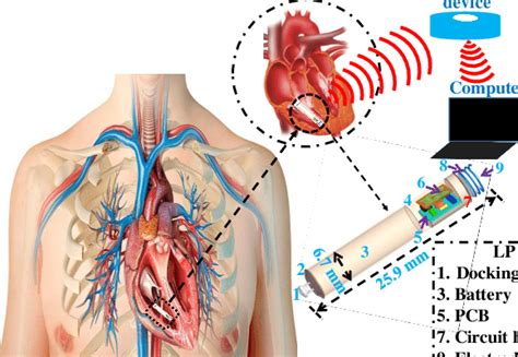 Detailed Architecture Of The Leadless Pacemaker And Its Components