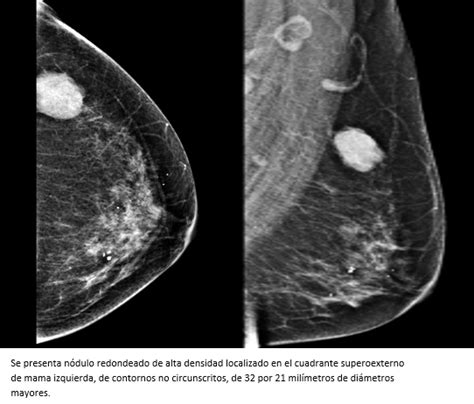 Carcinoma mucinoso de la mama reporte de caso y revisión de la