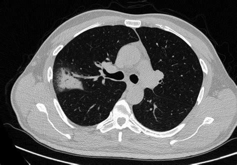 A Patch Of Airspace Consolidation With Air Bronchogram And Peripheral Download Scientific