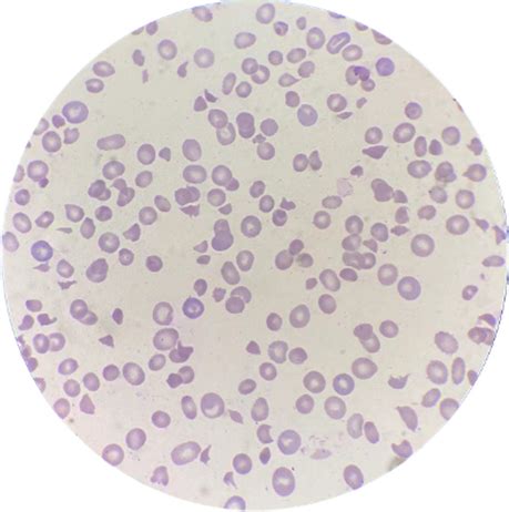 Patient’s peripheral blood smear showing schistocytes | Download ...