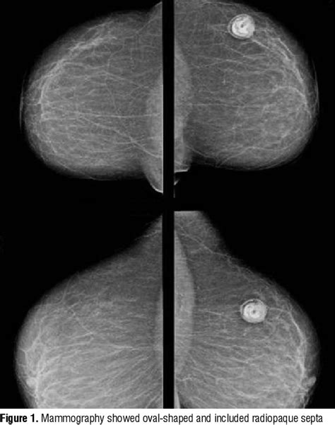 Figure 1 From Isolated Primary Hydatid Cyst Of The Breast Case Report Semantic Scholar