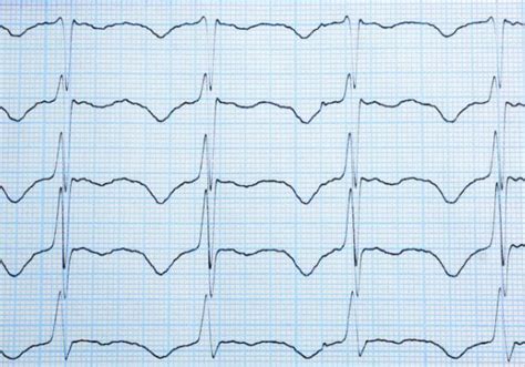 What Is An Irregular Heartbeat 1md