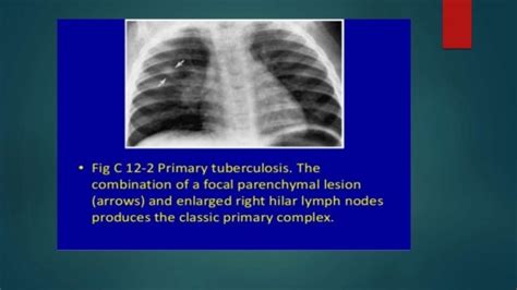 Hilar Enlargement Radiology