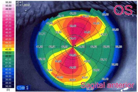 Topografía corneal En Ojopedia