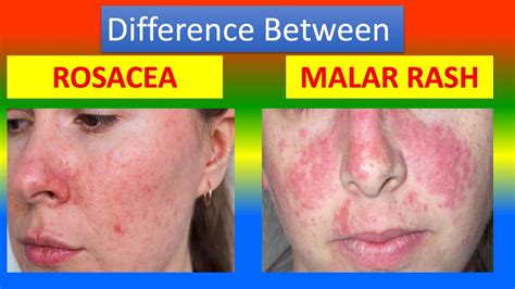 Rosacea Vs Lupus Butterfly Rash