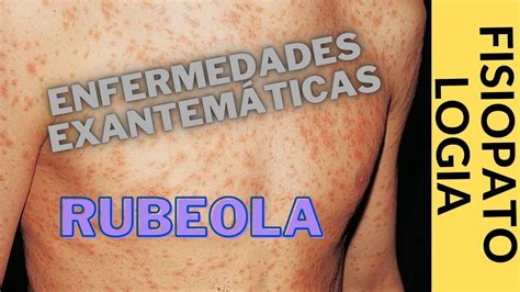 FISIOPATOLOGIA RUBEOLA Enfermedades Exantemáticas 1 YouTube